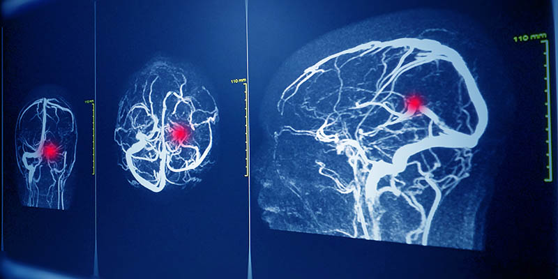 Imaging of the brain